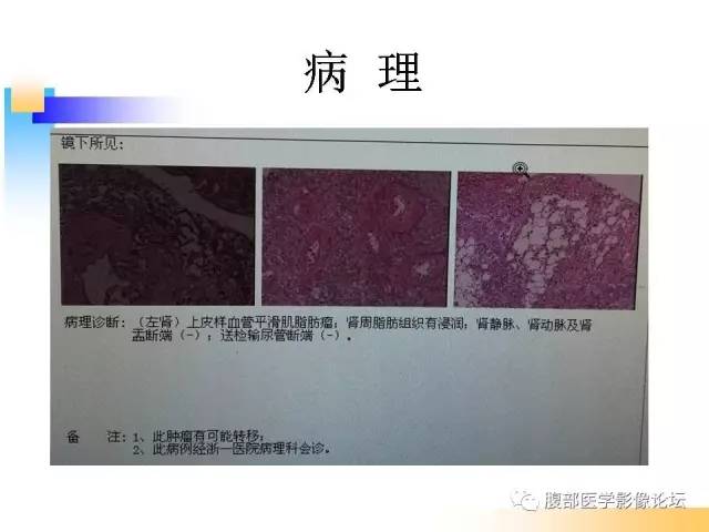 【病例】左肾上皮样血管平滑肌脂肪瘤1例CT