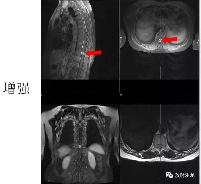 【病例】椎管内脊膜瘤1例MR影像表现