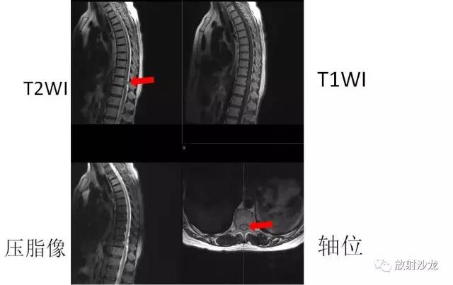 【病例】椎管内脊膜瘤1例MR影像表现