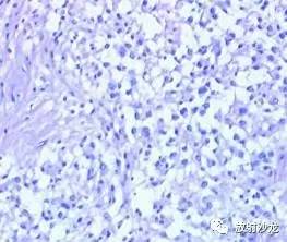 【病例】椎管内脊膜瘤1例MR影像表现