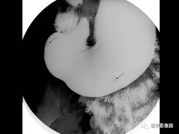 【PPT】胃肠息肉的病理及X线表现