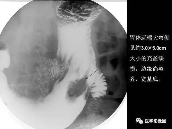 【PPT】胃肠息肉的病理及X线表现