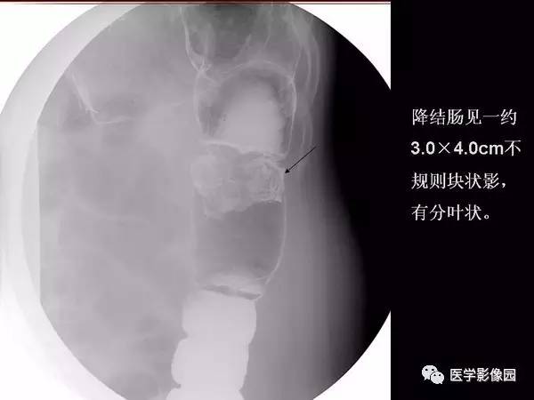 【PPT】胃肠息肉的病理及X线表现