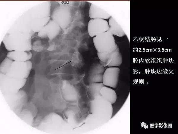 【PPT】胃肠息肉的病理及X线表现