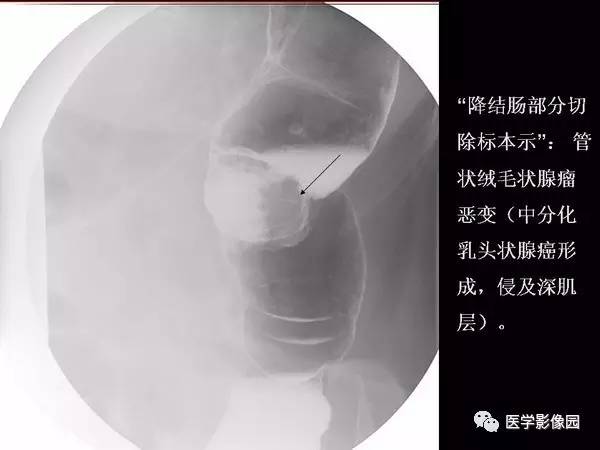 【PPT】胃肠息肉的病理及X线表现