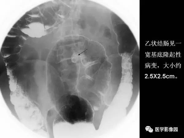 【PPT】胃肠息肉的病理及X线表现