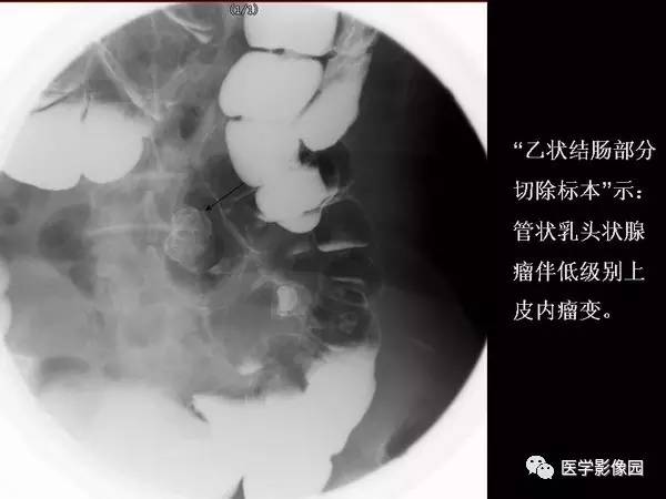 【PPT】胃肠息肉的病理及X线表现