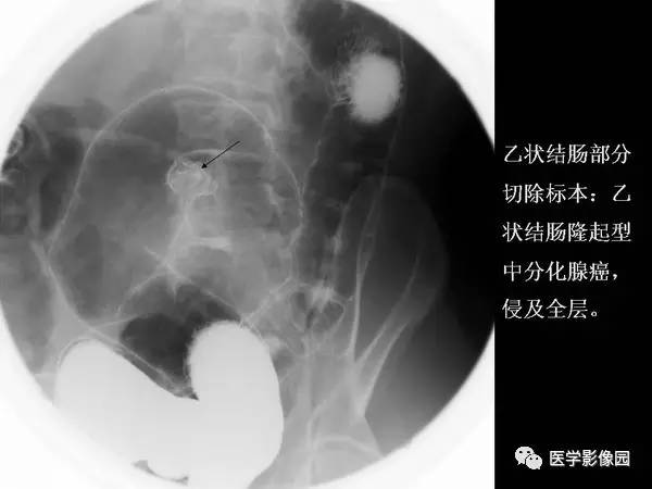 【PPT】胃肠息肉的病理及X线表现