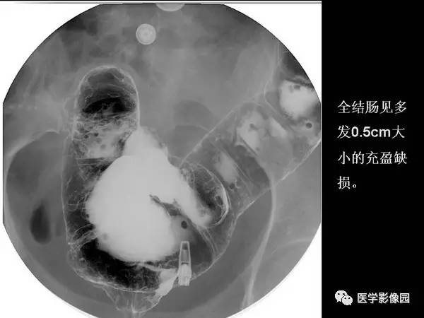 【PPT】胃肠息肉的病理及X线表现