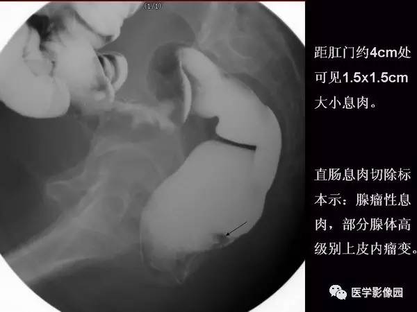【PPT】胃肠息肉的病理及X线表现