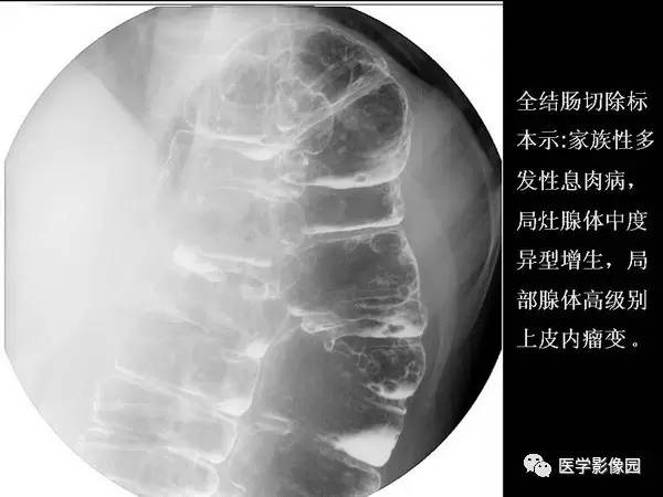 【PPT】胃肠息肉的病理及X线表现