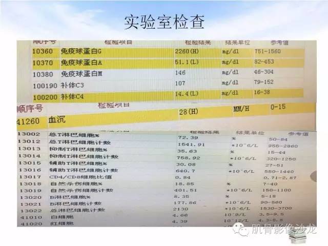 【病例】颅骨浆细胞瘤1例CT及MR