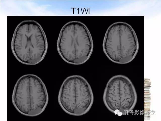 【病例】颅骨浆细胞瘤1例CT及MR