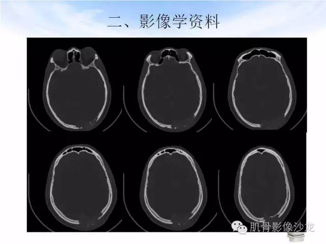 【病例】颅骨浆细胞瘤1例CT及MR