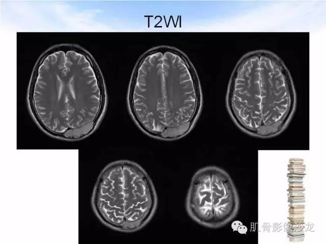 【病例】颅骨浆细胞瘤1例CT及MR