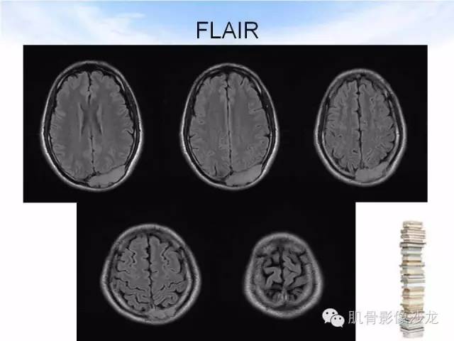 【病例】颅骨浆细胞瘤1例CT及MR
