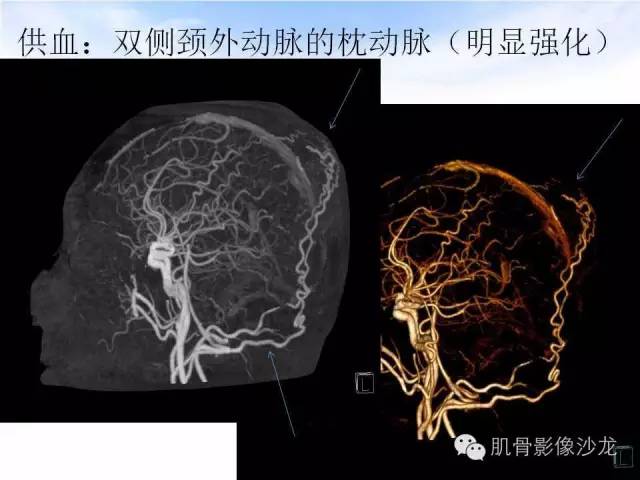 【病例】颅骨浆细胞瘤1例CT及MR