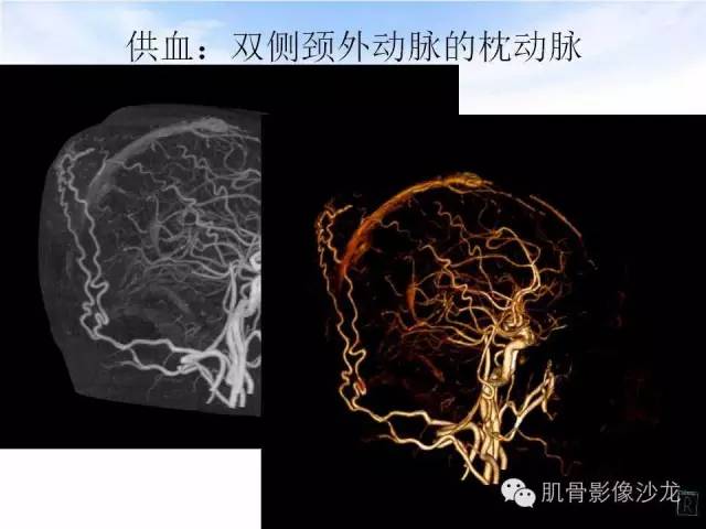 【病例】颅骨浆细胞瘤1例CT及MR