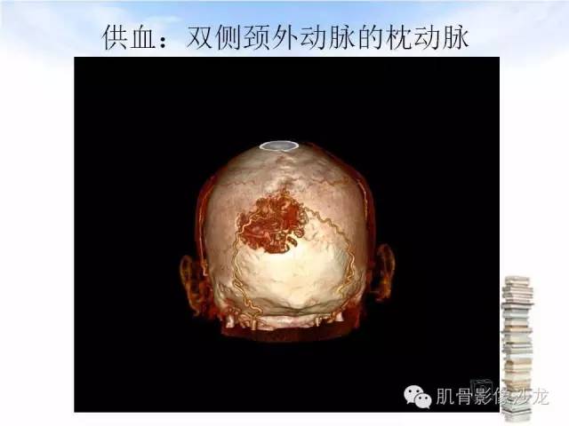 【病例】颅骨浆细胞瘤1例CT及MR