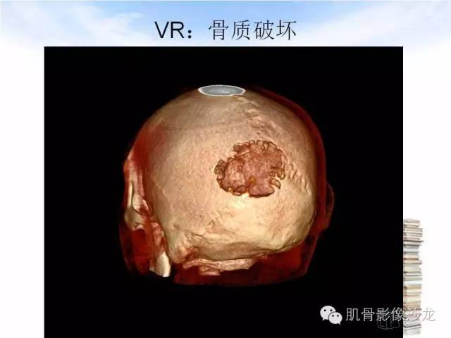【病例】颅骨浆细胞瘤1例CT及MR