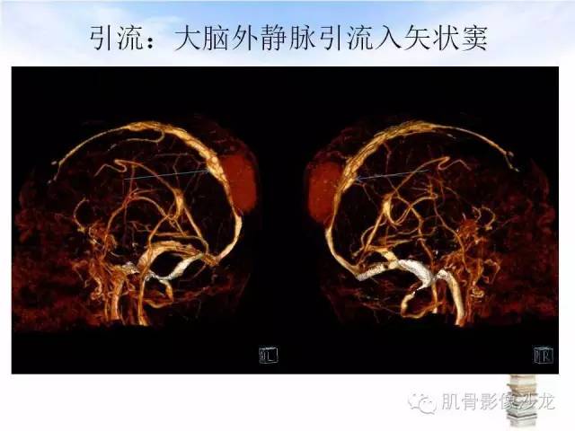 【病例】颅骨浆细胞瘤1例CT及MR