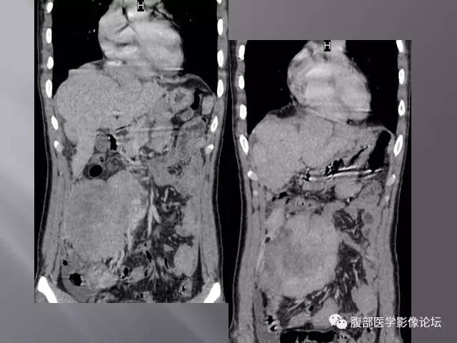 【病例】腹腔淋巴瘤1例CT影像表现