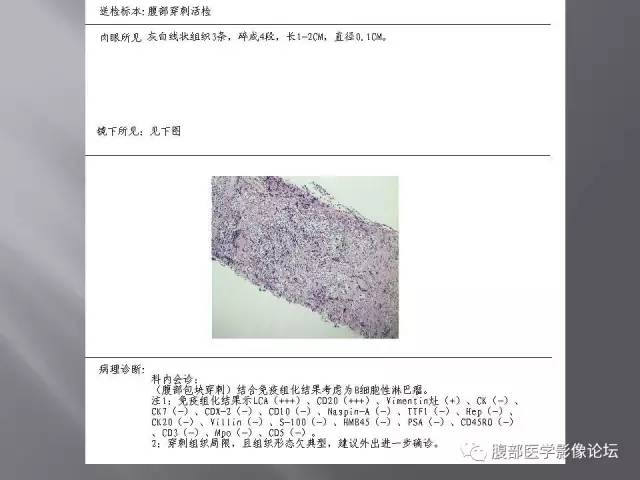【病例】腹腔淋巴瘤1例CT影像表现