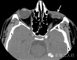 "扁平轮胎征"，这个征象提示啥？