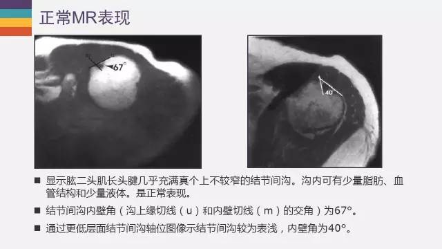 肱二头肌长头腱病变的MR诊断