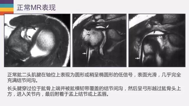 肱二头肌长头腱病变的MR诊断