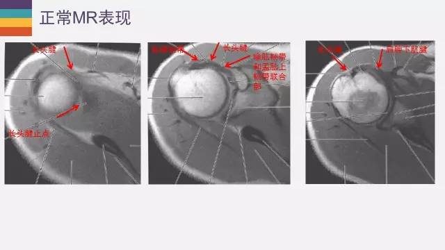 肱二头肌长头腱病变的MR诊断