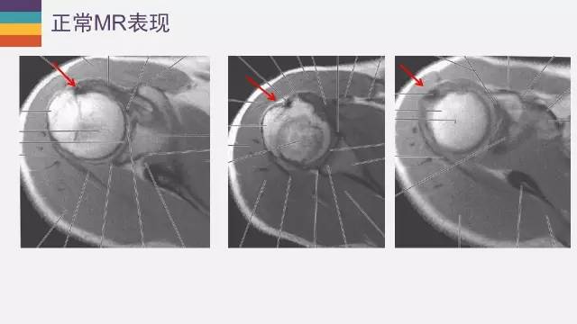 肱二头肌长头腱病变的MR诊断
