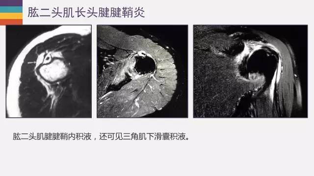 肱二头肌长头腱病变的MR诊断