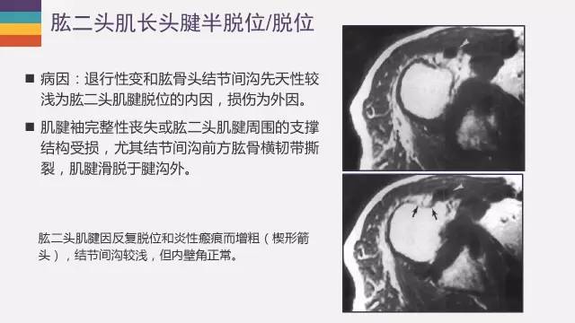 肱二头肌长头腱病变的MR诊断