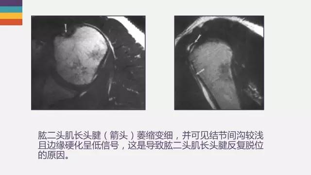 肱二头肌长头腱病变的MR诊断