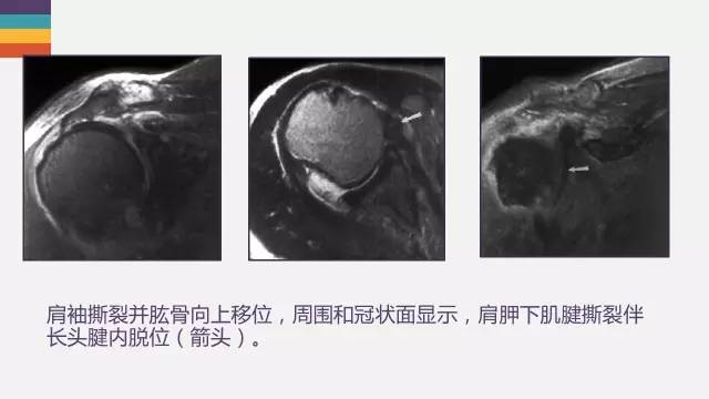 肱二头肌长头腱病变的MR诊断