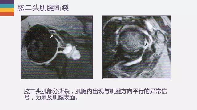 肱二头肌长头腱病变的MR诊断