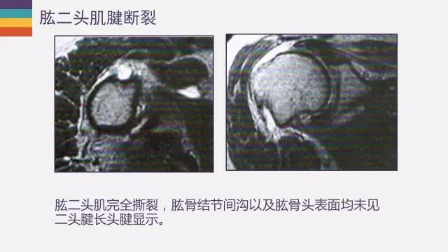 肱二头肌长头腱病变的MR诊断