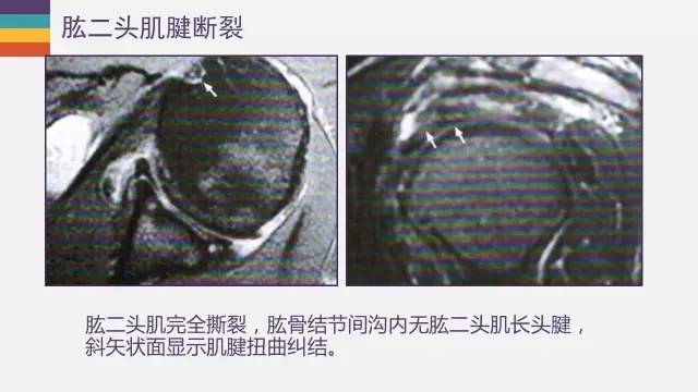 肱二头肌长头腱病变的MR诊断