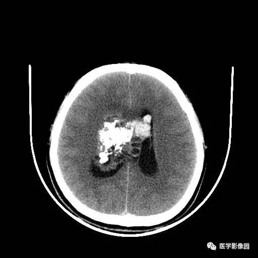 【病例】中枢神经细胞瘤1例MR影像表现