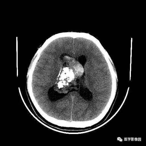 【病例】中枢神经细胞瘤1例MR影像表现 【病例】中枢神经细胞瘤1例MR影像表现