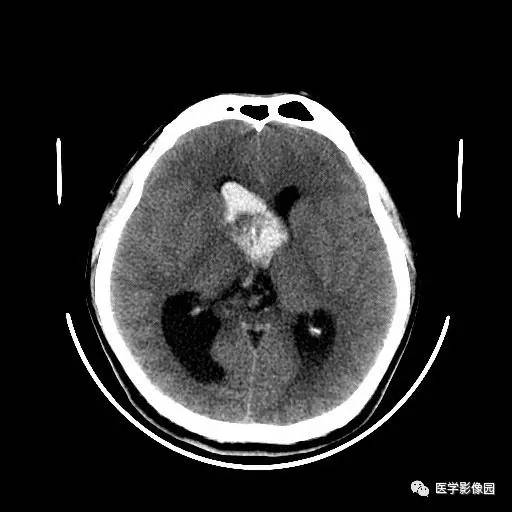 【病例】中枢神经细胞瘤1例MR影像表现 【病例】中枢神经细胞瘤1例MR影像表现