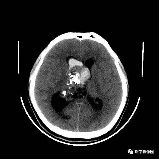 【病例】中枢神经细胞瘤1例MR影像表现 【病例】中枢神经细胞瘤1例MR影像表现