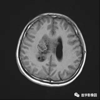 【病例】中枢神经细胞瘤1例MR影像表现 【病例】中枢神经细胞瘤1例MR影像表现
