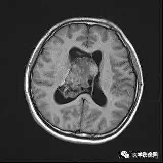 【病例】中枢神经细胞瘤1例MR影像表现 【病例】中枢神经细胞瘤1例MR影像表现