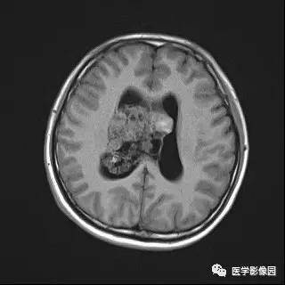 【病例】中枢神经细胞瘤1例MR影像表现 【病例】中枢神经细胞瘤1例MR影像表现