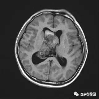 【病例】中枢神经细胞瘤1例MR影像表现 【病例】中枢神经细胞瘤1例MR影像表现