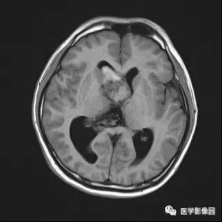 【病例】中枢神经细胞瘤1例MR影像表现 【病例】中枢神经细胞瘤1例MR影像表现