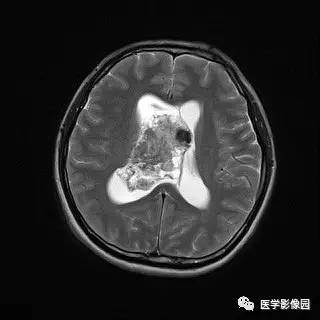 【病例】中枢神经细胞瘤1例MR影像表现 【病例】中枢神经细胞瘤1例MR影像表现