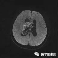 【病例】中枢神经细胞瘤1例MR影像表现 【病例】中枢神经细胞瘤1例MR影像表现